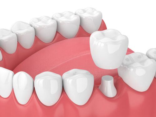 Corona dental, Tipos de coronas dentales
