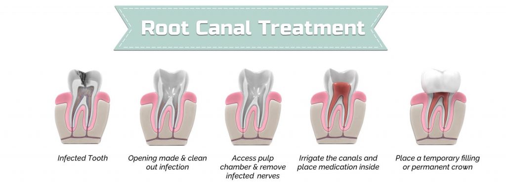 root canal los angeles